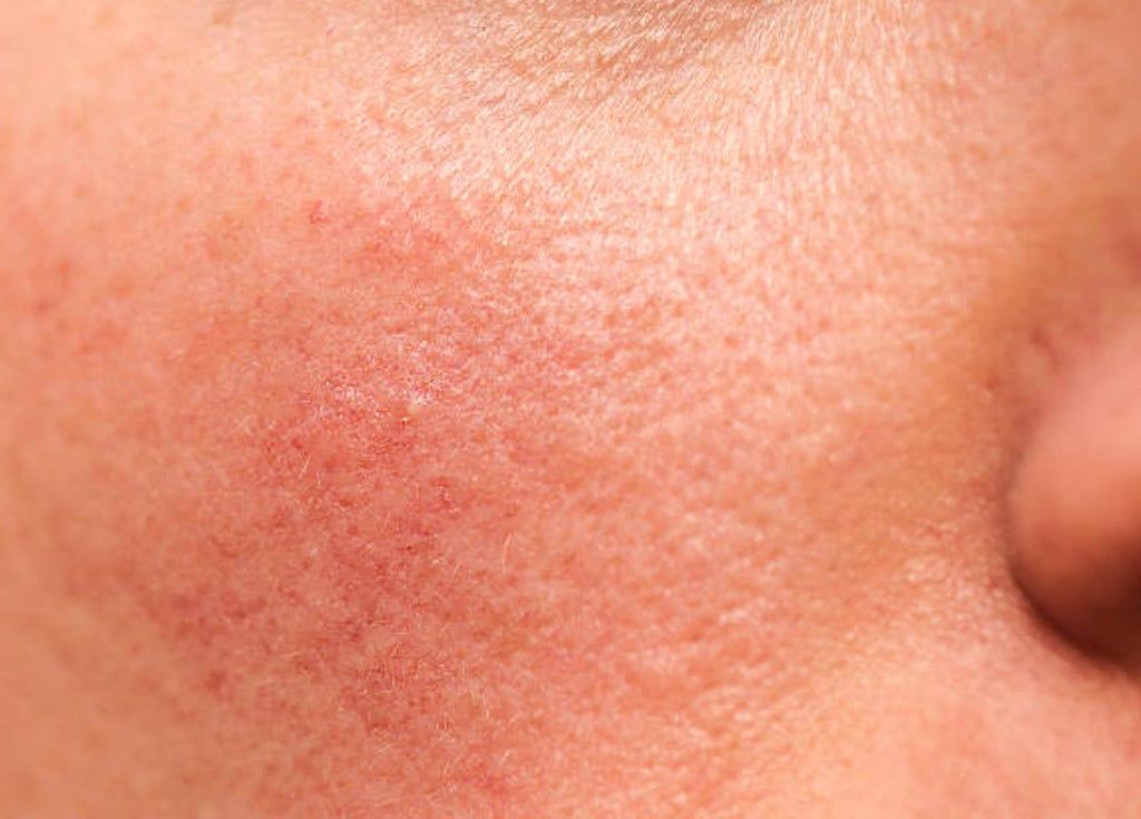 How to treat and manage Rosacea